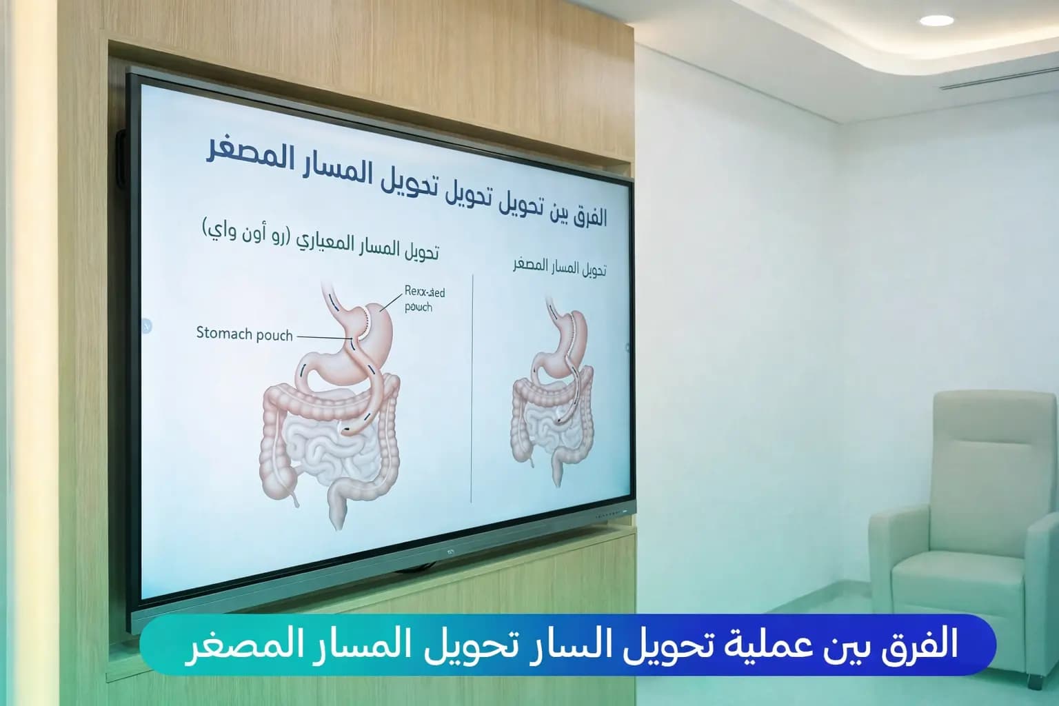 الفرق بين تحويل المسار وتحويل المسار المصغر لعلاج السمنة وفقدان الوزن